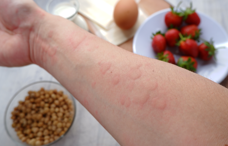 Como identificar e tratar alergias alimentares de forma eficaz